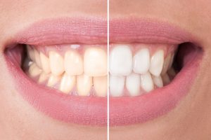 Top Ways to Get Super-White Teeth